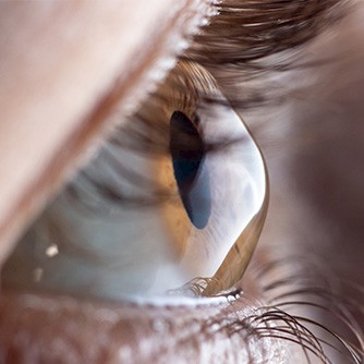 Corneal Cross-Linking